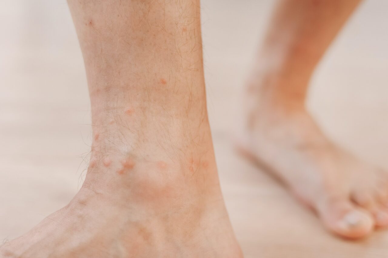 https://blog.workinpharma.fr/wp-content/uploads/2023/10/close-up-allergic-rash-dermatitis-eczema-on-man-fo-2023-08-01-00-01-41-utc-1280x853.jpg